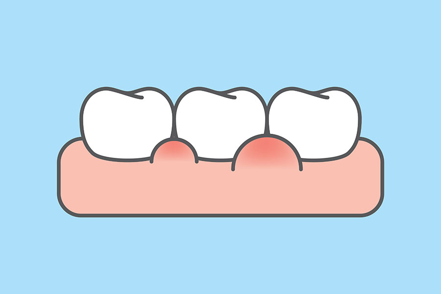 みよし市　歯医者　歯ぐきの出血や腫れの原因と対処方法　後藤歯科
