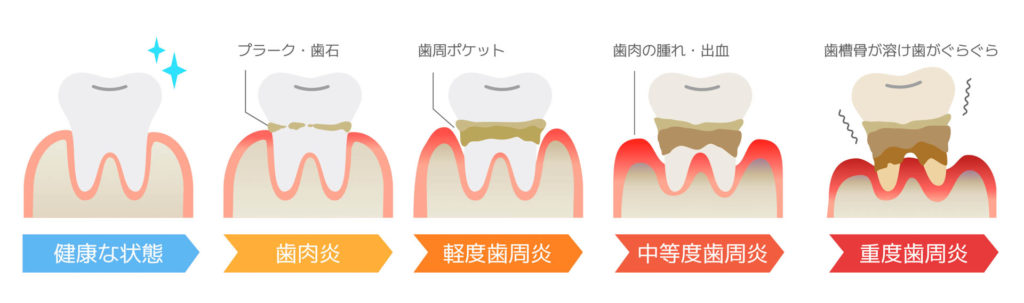歯周病進行度