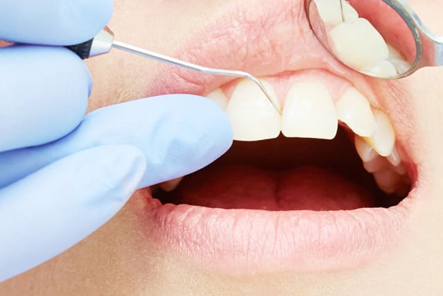 歯周病の基本的な処置内容