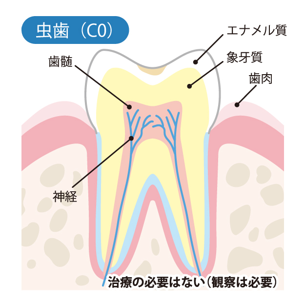 みよし市東陣取山の歯医者、後藤歯科の虫歯治療