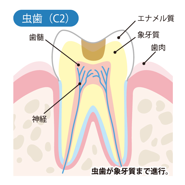 みよし市東陣取山の歯医者、後藤歯科の虫歯治療