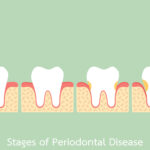 みよし市　歯医者　歯周病とは？歯槽膿漏との違いとは　後藤歯科